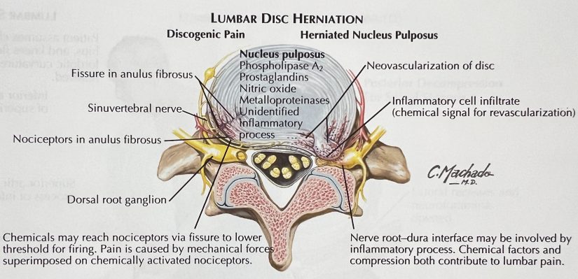 Lumbar Disc Herniation medical illustration.